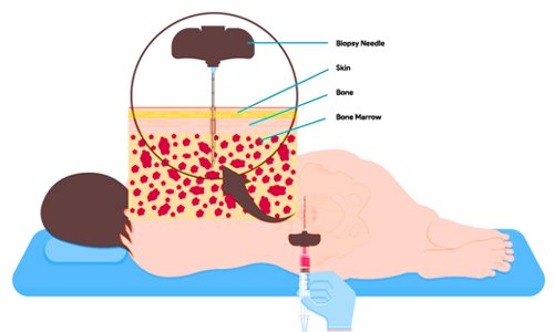 Biopsy in Nagpur
