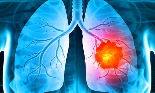 lung cancer treatment in nagpur