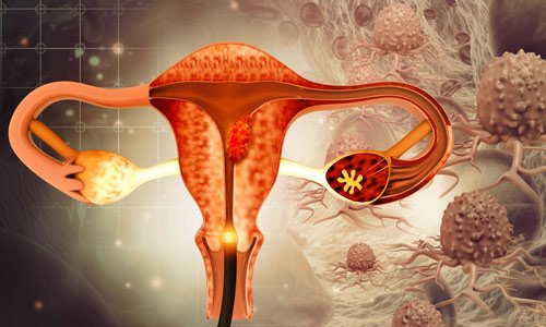 Ovarian Cancer Treatment in Nagpur