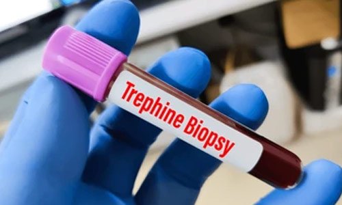 Trephine Biopsy in Nagpur